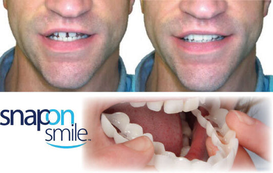 Carillas Postiza Dentadura SnapOn Smile